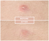 Beauty Skin tag & Acne Patch (24 Pieces)